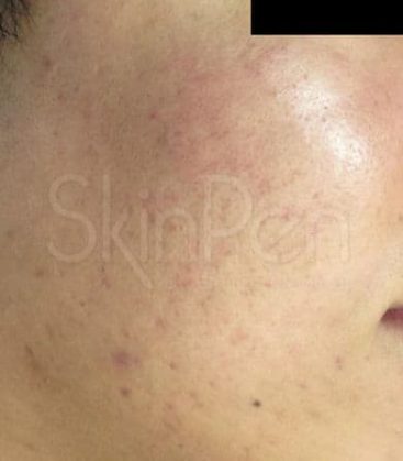 selphyl-skin-treatment-after